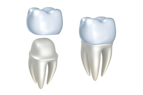 Natural Looking Porcelain Crowns
