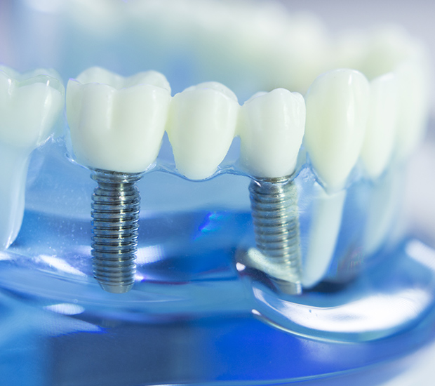 Paramus Dental Implants